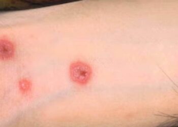 ആന്റിബയോട്ടിക്-കഴിച്ച-മോഡലിന്റെ-ശരീരം-മുഴുവന്‍-ചൊറിഞ്ഞുപൊട്ടി;-ഒരു-കണ്ണിന്റെ-കാഴ്ചയും-നഷ്ടപ്പെട്ടു