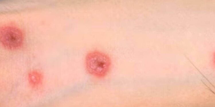 ആന്റിബയോട്ടിക്-കഴിച്ച-മോഡലിന്റെ-ശരീരം-മുഴുവന്‍-ചൊറിഞ്ഞുപൊട്ടി;-ഒരു-കണ്ണിന്റെ-കാഴ്ചയും-നഷ്ടപ്പെട്ടു