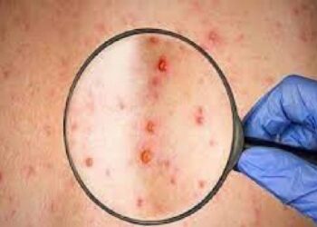 കോംഗോയിൽ-എംപോക്സ്-രോഗബാധിതർ-14000ത്തിൽ-അധികം,-മരണം-511;-ലോകാരോഗ്യ-സംഘടനയുടെ-ജാഗ്രതാ-നിർദ്ദേശം