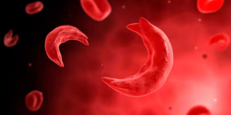 ‘ശ്രദ്ധിക്കേണ്ട-കാര്യങ്ങള്‍,-ചികിത്സാ-കേന്ദ്രം,-സഹായ-പദ്ധതികള്‍’;-ഒരു-വർഷം-ക്യാമ്പയിന്‍-‘അറിയാം-അകറ്റാം-അരിവാള്‍കോശ-രോഗം’