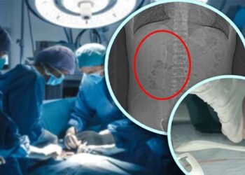 അടിച്ചു-പാമ്പായി-അബ​ദ്ധത്തിൽ-വിഴുങ്ങിയത്-സ്പൂൺ,-സംഭവം-തിരിച്ചറഞ്ഞത്-ആറുമാസത്തിനു-ശേഷം-നടത്തിയ-സ്കാനിങ്ങിൽ,-ശസ്ത്രക്രിയയിലൂടെ-സ്പൂൺ-പുറത്തെടുത്തു