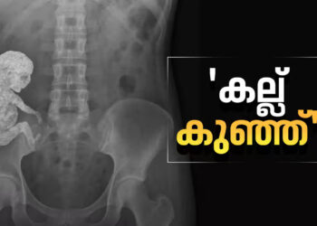 ‘കല്ല്-കുഞ്ഞ്’;-അമ്മയുടെ-ശരീരത്തിൽ-കാൽസ്യം-നിറഞ്ഞ-‘സ്റ്റോൺ-ബേബി’,-എക്സ്-റേ-ചിത്രം-പങ്കുവച്ച്-ഡോക്ടർ,-അമ്പരന്ന്-ലോകം