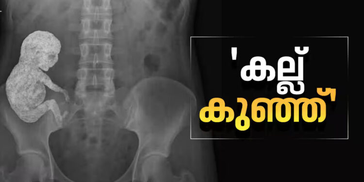‘കല്ല്-കുഞ്ഞ്’;-അമ്മയുടെ-ശരീരത്തിൽ-കാൽസ്യം-നിറഞ്ഞ-‘സ്റ്റോൺ-ബേബി’,-എക്സ്-റേ-ചിത്രം-പങ്കുവച്ച്-ഡോക്ടർ,-അമ്പരന്ന്-ലോകം