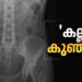 ‘കല്ല്-കുഞ്ഞ്’;-അമ്മയുടെ-ശരീരത്തിൽ-കാൽസ്യം-നിറഞ്ഞ-‘സ്റ്റോൺ-ബേബി’,-എക്സ്-റേ-ചിത്രം-പങ്കുവച്ച്-ഡോക്ടർ,-അമ്പരന്ന്-ലോകം