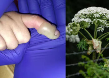 ഡേ-കെയറിൽ-പോകുന്ന-വഴിയിൽ-തൊട്ടത്-വിഷച്ചെടിയിൽ,-3-വയസുകാരന്റെ-വിരലുകൾ-പൊള്ളിവീർത്തു