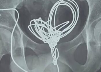 മൂത്രനാളിയിലേക്ക്-മൂന്ന്-മീറ്ററോളം-നീളമുള്ള-ഇലക്ട്രിക്-വയർ-കുത്തിക്കയറ്റി-യുവാവ്