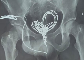 മൂത്രനാളിയിലേക്ക്-യുവാവ്-കുത്തിക്കയറ്റിയത്-മൂന്ന്-മീറ്ററോളം-ഇലക്ട്രിക്-വയർ;-പുറത്തെടുത്തത്-വയർ-തുറന്നുള്ള-ശസ്ത്രക്രിയയിലൂടെ