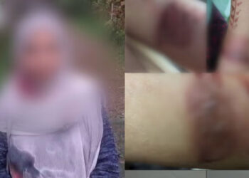 ഭിന്നശേഷിക്കാരിയായ-യുവതിയുടെ-കൈ-ചൂടുവെള്ളം-ഒഴിച്ച്-പൊള്ളിച്ചു,-അധ്യാപികയ്ക്കെതിരെ-പരാതി