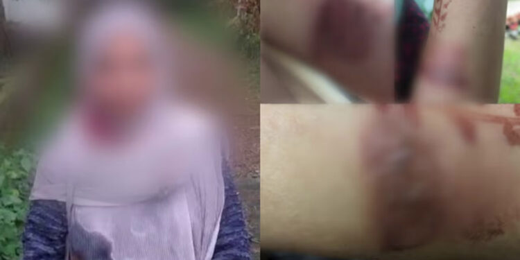 ഭിന്നശേഷിക്കാരിയായ-യുവതിയുടെ-കൈ-ചൂടുവെള്ളം-ഒഴിച്ച്-പൊള്ളിച്ചു,-അധ്യാപികയ്ക്കെതിരെ-പരാതി