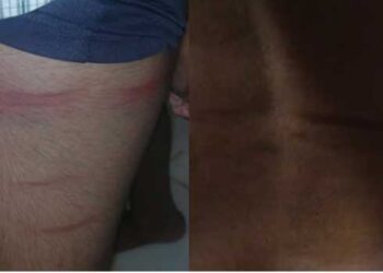 വിദ്യാർഥിയുടെ-കാലിലും-ദേഹത്തും-അടികൊണ്ട്-തിമിർത്ത-പാടുകൾ,-അവധിയെടുത്ത-പത്താം-ക്ലാസുകാരന്-ക്ലാസ്-ടീച്ചറിന്റെ-ക്രൂര-മർദനം,പോലീസിൽ-പരാതി