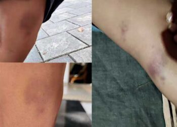 പഠിക്കാത്തതിന്-കുരുന്നിനോട്-അംഗൻവാടി-ടീച്ചറുടെ-ക്രൂരത!!-നാലര-വയസുകാരന്റെ-രണ്ട്-കാലിലെയും-തുടയിൽ-രക്തം-കട്ടപിടിച്ച-പാടുകൾ…-ക്ഷമിക്കണമെന്ന്-അംഗൻവാടി-ടീച്ചർ,-അക്ഷരം-പഠിപ്പിക്കുന്നതിനിടെ-സംഭവിച്ചത്-അധികൃതർ