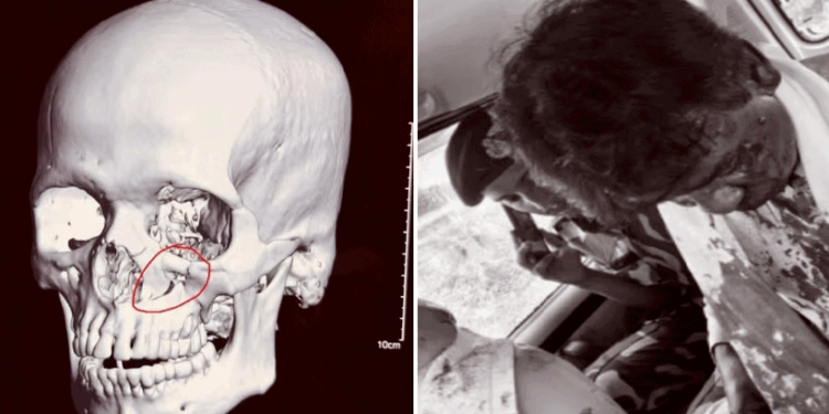 ‘കാഴ്ച-നഷ്ടപ്പെട്ടേനെ’.!-കല്ലെറിഞ്ഞ്-കണ്ണിനു-താഴെ-ഒടിവ്,-ബിജെപി-എംപി-ആശുപത്രിയിൽ