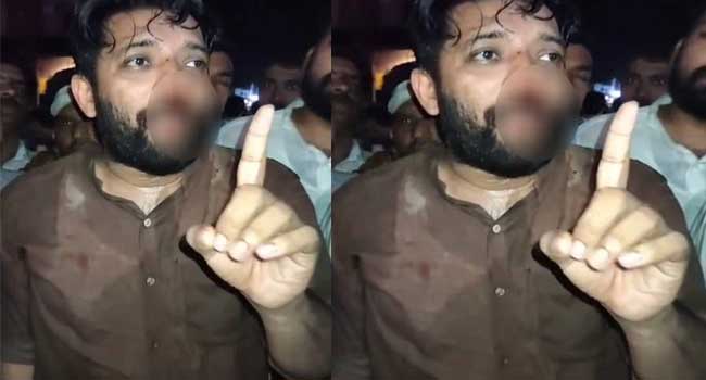 ഷാഫി-പറമ്പിൽ-എംപിയുടെ-മൂക്കിന്റെ-ഇടത്-വലത്-അസ്ഥികളിൽ-പൊട്ടൽ,-ഇടത്-അസ്ഥികളുടെ-സ്ഥാനം-തെറ്റി,-ആരോഗ്യനില-തൃപ്തികരം-മെഡിക്കൽ-ബുളളറ്റിൻ