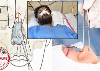 ഷാഫി-പറമ്പിലിനു-നടത്തിയത്-നേസൽ-ബോൺ-ഫ്രാക്ച്ചർ-റിഡക്ഷൻ,-എൻഡോസ്കോപിക്-സെപ്റ്റോപ്ലാസ്റ്റി-സർജറികൾ,-ഇതിന്-താടിയോ,-മുടിയോ-നീക്കം-ചെയ്യേണ്ട-ഷാഫിയുടെ-ശസ്ത്രക്രിയ-നടത്തിയ-ഡോക്ടർമാർ-പറയുന്നത്-(വീഡിയോ)