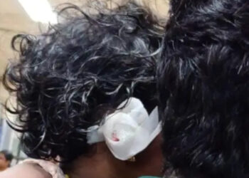 കളിച്ചുകൊണ്ടിരുന്ന-മൂന്ന്-വയസുകാരിയുടെ-ചെവി-തെരുവുനായ-കടിച്ചെടുത്തു,-അറ്റുപോയ-ഭാ​ഗം-പ്ലാസ്റ്റിക്-സർജറിയിലൂടെ-വെച്ചുപിടിപ്പിച്ചു,-ശസ്ത്രക്രിയ-വിജയിച്ചോയെന്ന-കാര്യത്തിൽ-വ്യക്തതയില്ലെന്ന്-ഡോക്ടർമാർ,-മറ്റൊരു-ശസ്ത്രക്രയയ്ക്ക്-വിധേയയാക്കും