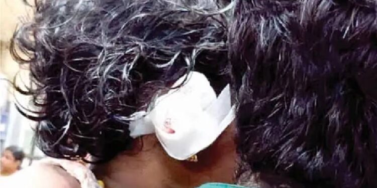 മൂന്ന്-വയസുകാരിയുടെ-ചെവി-തെരുവ്-നായ-കടിച്ചെടുത്ത-സംഭവം;-നിഹാരയുടെ-ചെവി-പുനഃസ്ഥാപിക്കൽ-ശസ്ത്രക്രിയ-പരാജയം