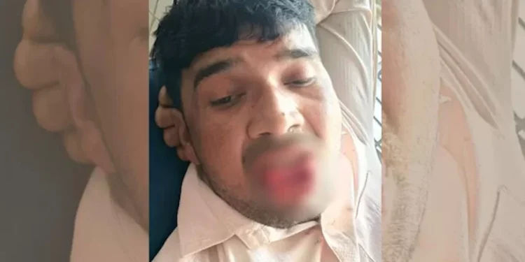 വിവാഹം-നിശ്ചയിച്ച-യുവതിയെ-ചുംബിക്കാൻ-ശ്രമിച്ചാൽ?-മുൻ-കാമുകന്-കിട്ടിയത്-എട്ടിന്റെ-പണി;-നാക്ക്-കടിച്ചെടുത്തു,-ശസ്ത്രക്രിയ!