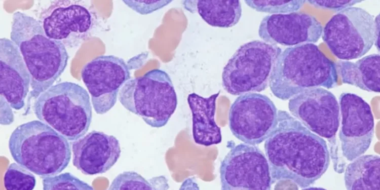 അക്യൂട്ട്-മൈലോയ്ഡ്-ലുക്കീമിയ!-അവഗണിക്കരുത്-ഈ-ലക്ഷണങ്ങൾ;-പ്രായഭേദമന്യേ-രോഗബാധയെന്ന്-മുന്നറിയിപ്പ്