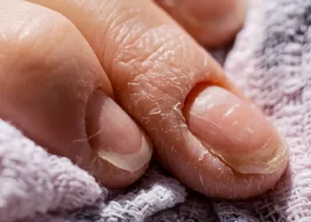 നഖത്തിലെ-ഈ-മാറ്റം-നിസ്സാരമല്ല;-പിന്നിൽ-ഒളിഞ്ഞിരിക്കുന്നത്-മാരക-രോഗങ്ങളാകാം!