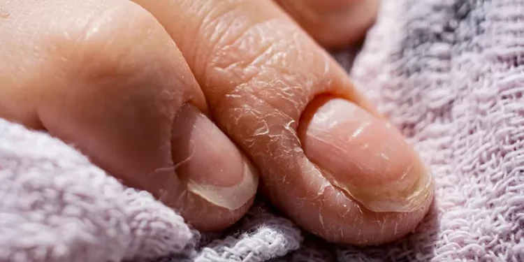 നഖത്തിലെ-ഈ-മാറ്റം-നിസ്സാരമല്ല;-പിന്നിൽ-ഒളിഞ്ഞിരിക്കുന്നത്-മാരക-രോഗങ്ങളാകാം!