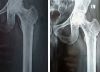 രക്തയോട്ടം-കൂട്ടാനുള്ള-ശസ്ത്രക്രിയക്കിടെ-ഡ്രിൽ-ബിറ്റ്-ഒടിഞ്ഞു-ഇടുപ്പ്-എല്ലിൽ-കയറി,-ലോഹ-കഷണം-നീക്കം-ചെയ്യാനാകില്ല,-അത്-അങ്ങനെ-ഇരിക്കുന്നതുകൊണ്ട്-പ്രശ്നങ്ങളുണ്ടാകില്ല,-ആശുപത്രി-അധികൃതരുടെ-വിശദീകരണം!!-തിരുവനന്തപുരം-ജൂബിലി-മെമ്മോറിയൽ-ആശുപത്രിയിൽ-​ഗുരുതര-ചികിത്സാ-പിഴവ്,-കേസ്