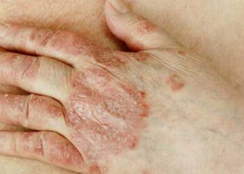 ത്വക്കിലുണ്ടാകുന്ന-എല്ലാ-പാടുകളും-ചുണങ്ങെന്നു-കരുതി-അവ​ഗണിക്കല്ലേ…വിട്ടൊഴിഞ്ഞെന്നു-കരുതിയ-മാരക-രോ​ഗം-കേരളത്തിൽ-വീണ്ടും-…179-പേർക്ക്-പുതുതായി-കുഷ്ഠരോ​ഗബാധ!