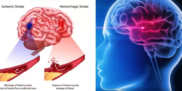 സ്ട്രോക്കിന്റെ-ഈ-ലക്ഷണങ്ങൾ-അവഗണക്കരുത്:-സമയബന്ധിതമായ-ചികിത്സ-ജീവൻ-രക്ഷിക്കും