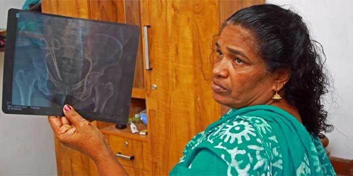 രണ്ട്-സർക്കാർ-ഡോക്ടർമാരുടെ-സാന്നിധ്യത്തിൽ-ഉഷയുടെ-ശസ്ത്രക്രിയ-പൂർത്തിയായി,-കത്രിക-പുറത്തെടുത്തു,-തൊണ്ടുമുതൽ-അമ്പലപ്പുഴ-ഡിവൈഎസ്പിക്ക്-കൈമാറി