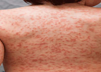 കട്ടപ്പനയിൽ-ഒന്നരവയസുകാരിയ്ക്ക്-അപൂർവവും-​ഗുരുതരവുമായ-കവാസാക്കി-രോഗം-സ്ഥിരീകരിച്ചു